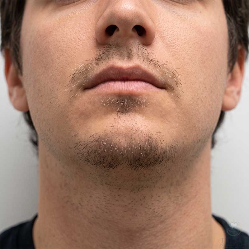 Patchy Beard Before Transplant