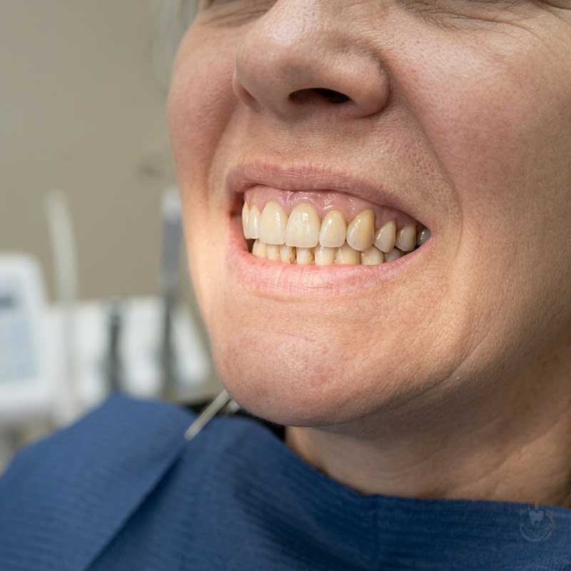 Advanced Dental Implants After