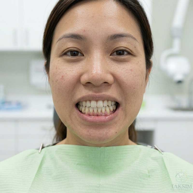 Dental Implants After