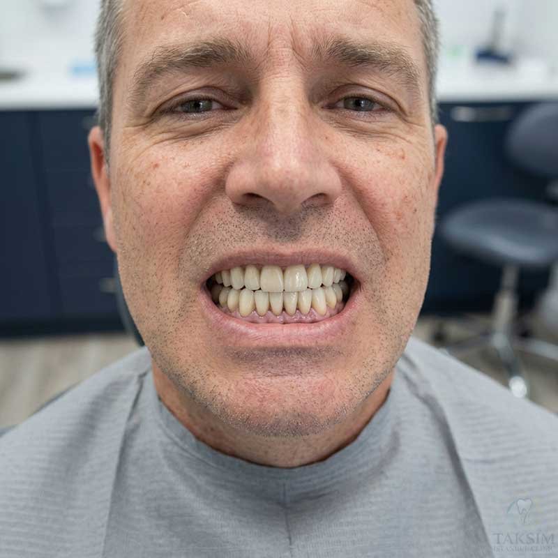 Dental Implants After