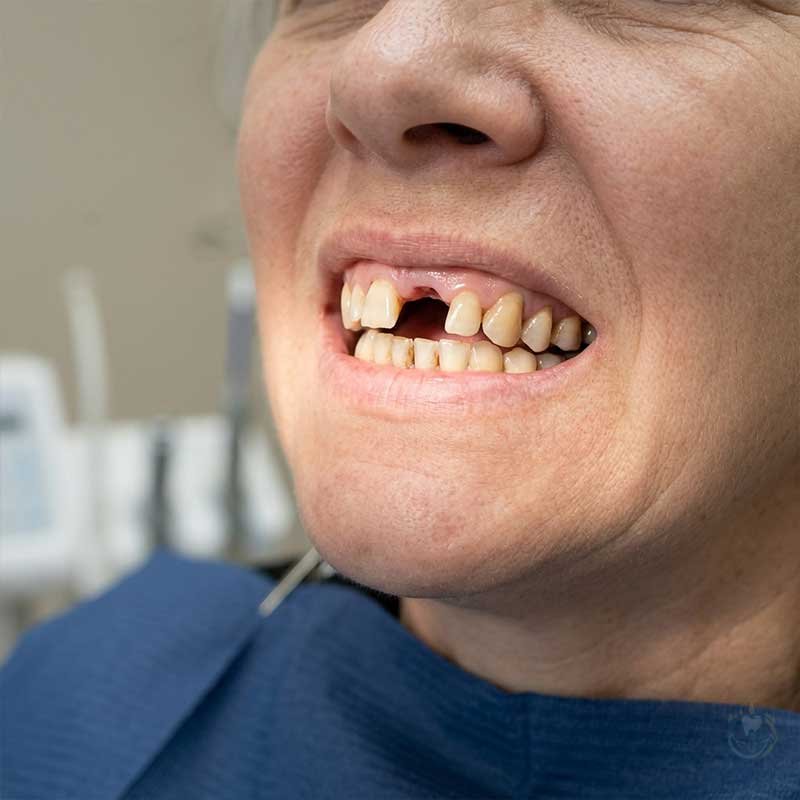 Advanced Dental Implants Before