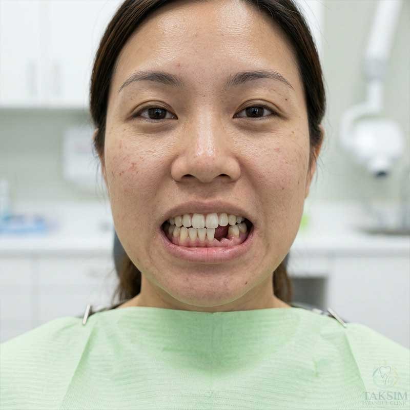 Missing Teeth Before