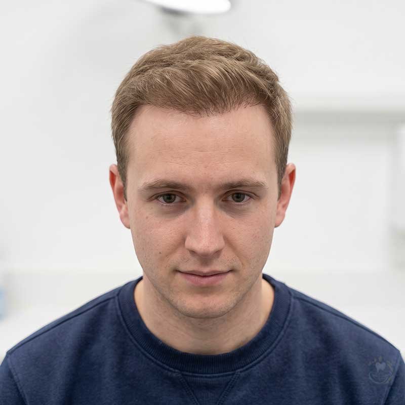 Crown Hair Transplant Result After
