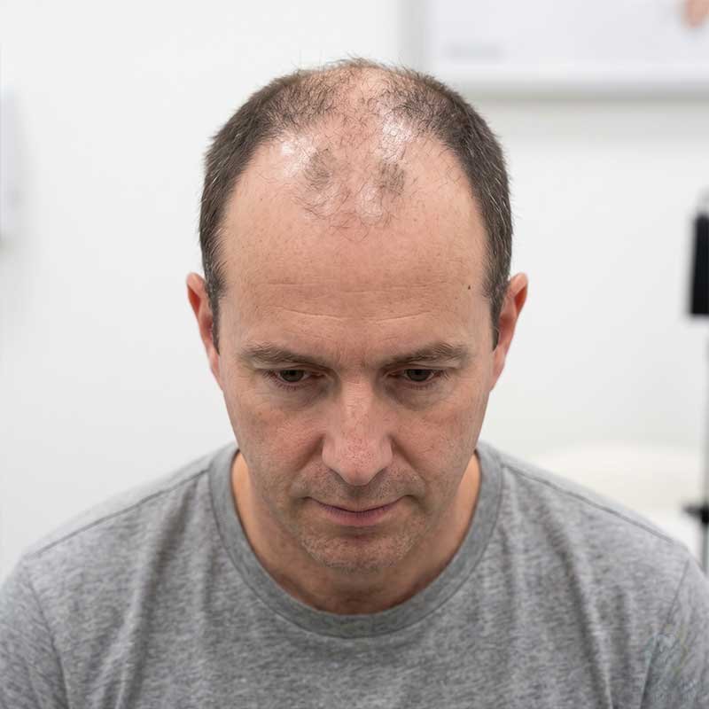Before FUE Transplant
