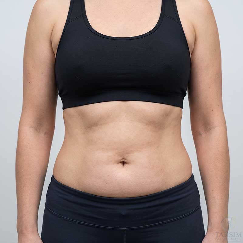 After Liposuction