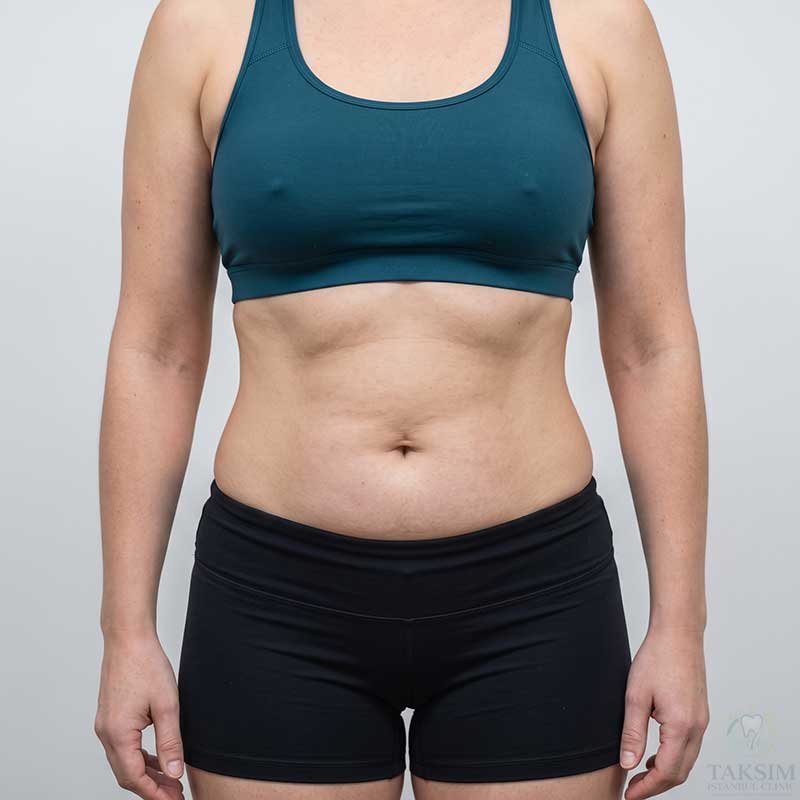 Body Sculpting After Transformation