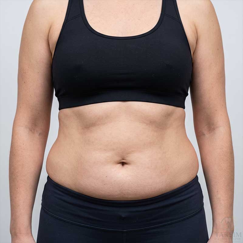 Before Liposuction