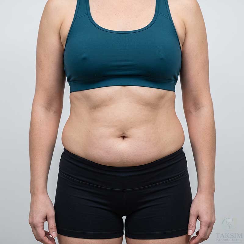 Body Sculpting Before