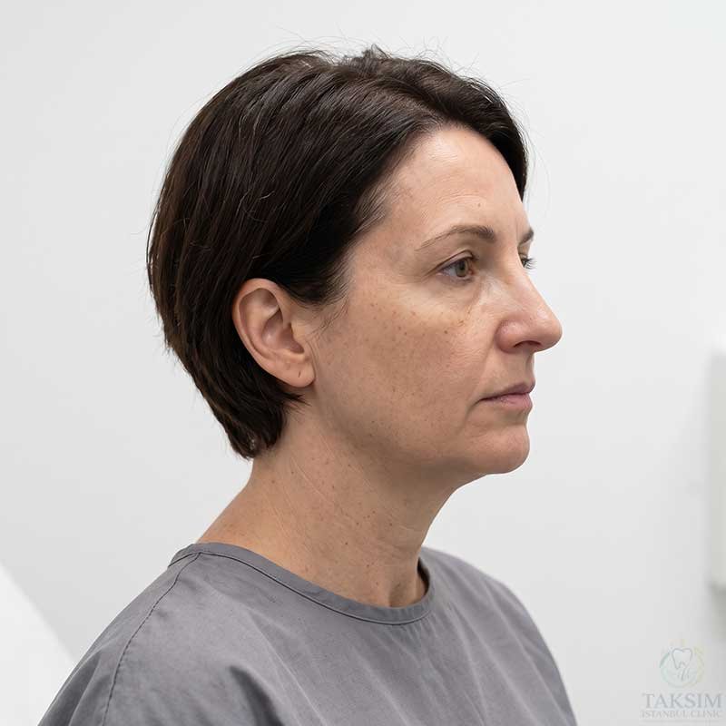Plastic Surgery After Transformation