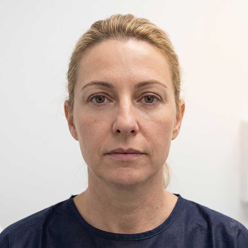 Cosmetic Procedure After