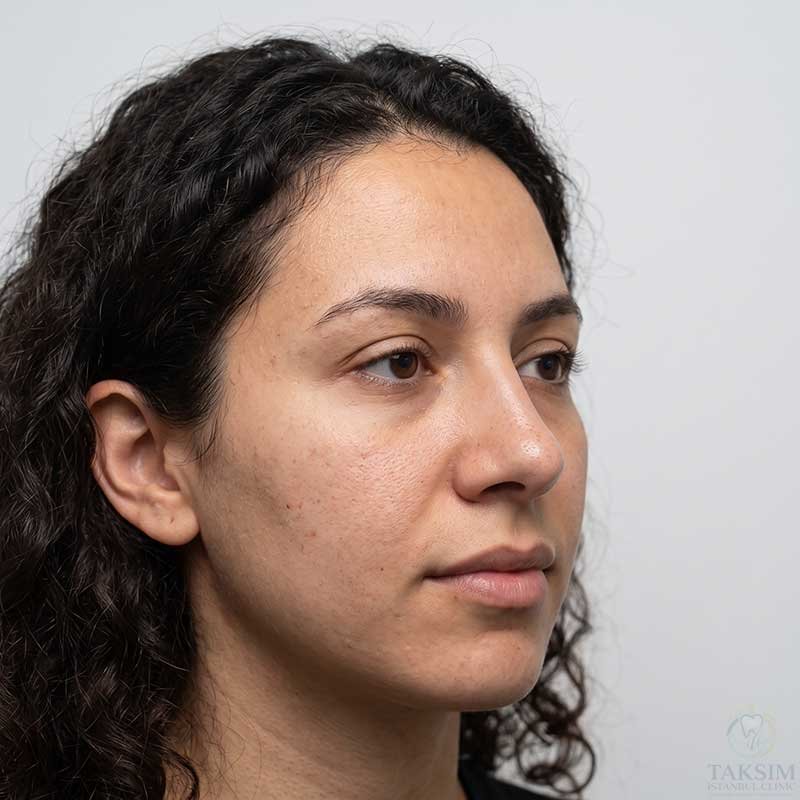 Nose Job After Transformation