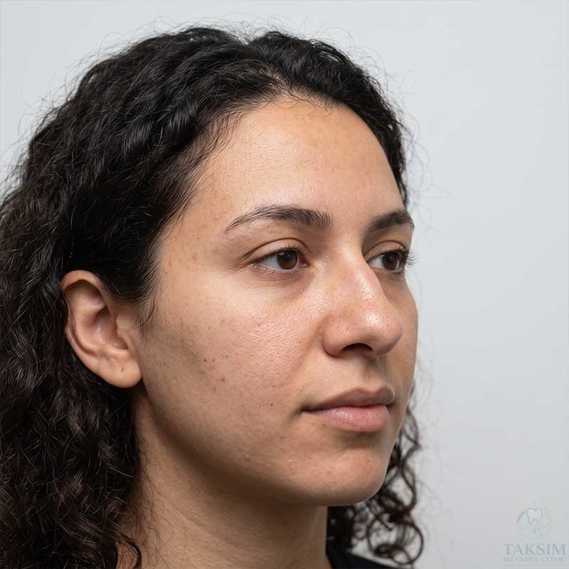 Nose Before Surgery