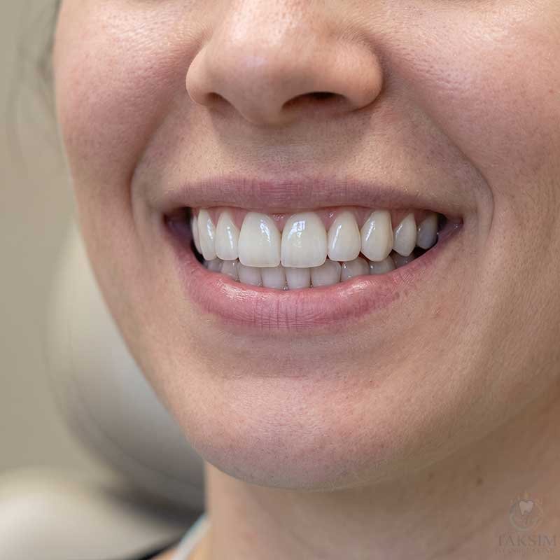 Porcelain Veneers Turkey