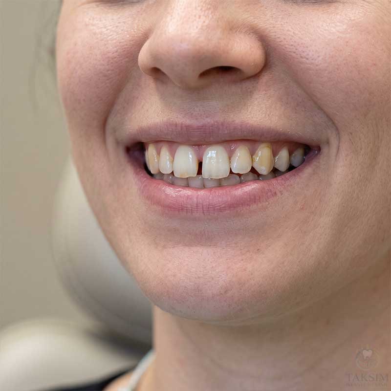 Dental Veneers Before