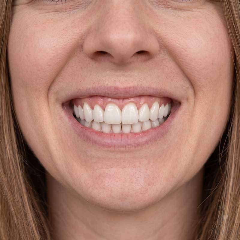 Zirconia Crowns Turkey