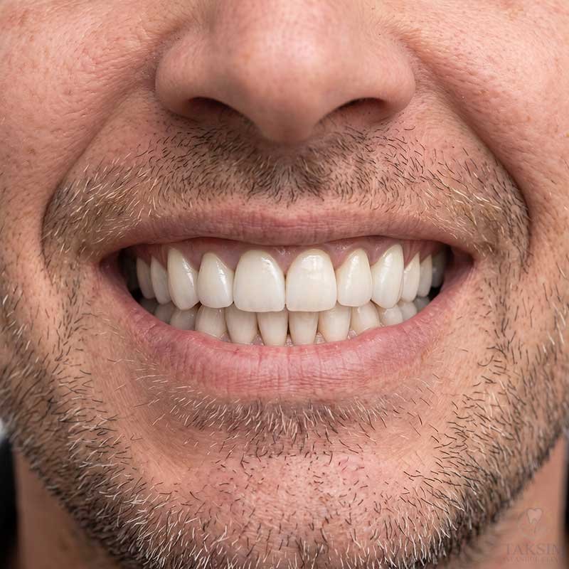 After Zirconia Crowns