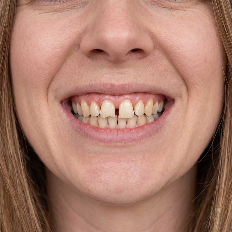 Damaged Teeth Before Zirconia