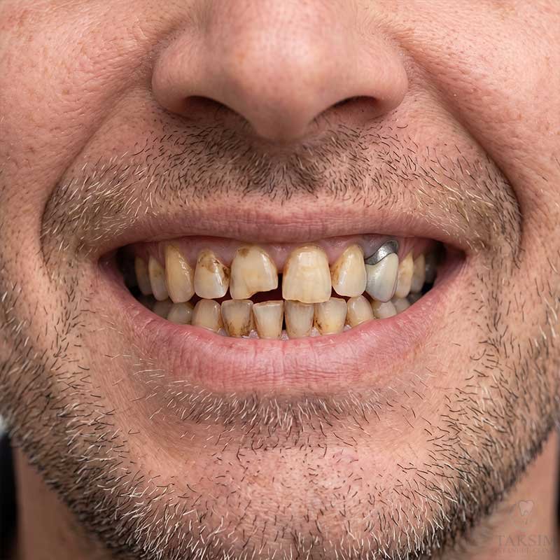 Before Zirconia Crowns