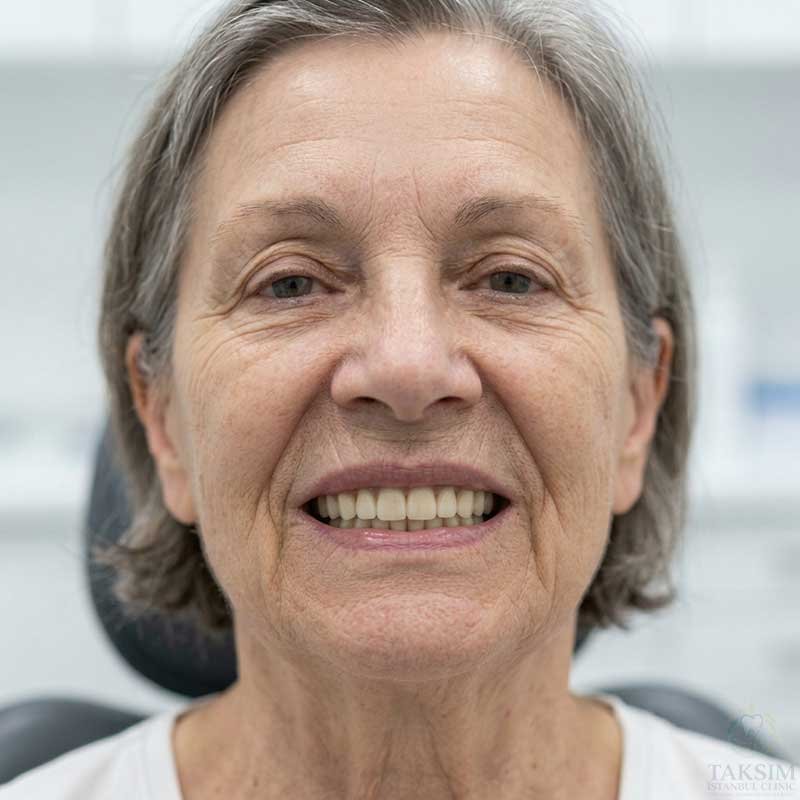 After Zygomatic Implants