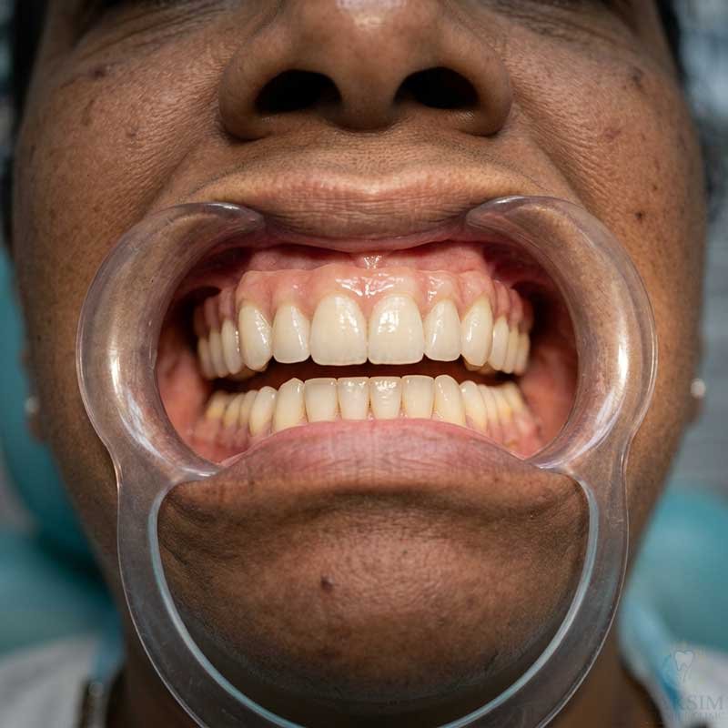 After Zygomatic Implants