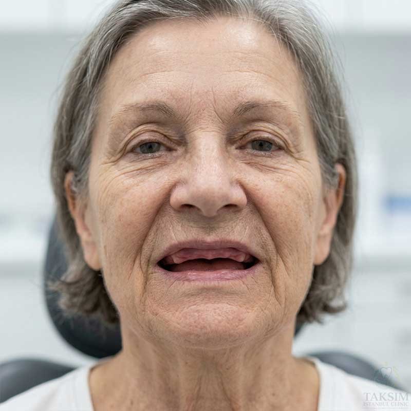Before Zygomatic Implants