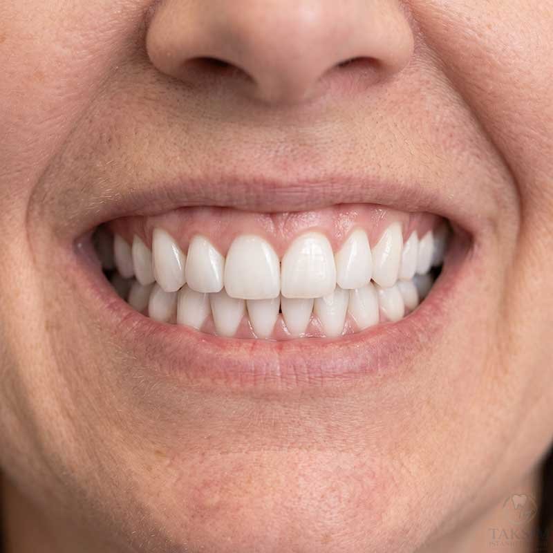 Hollywood Smile After Porcelain Veneers