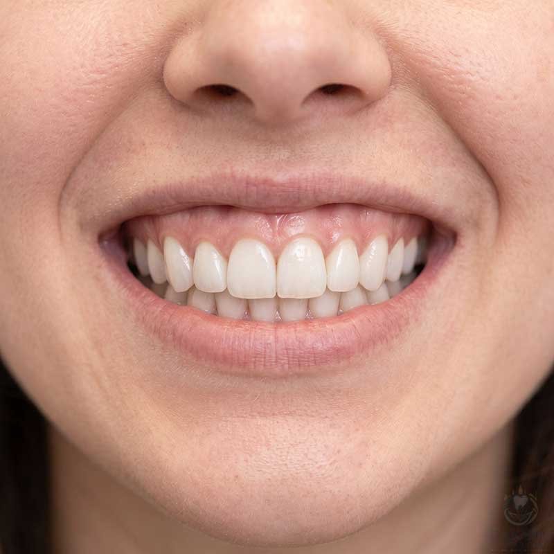 Anterior Restoration After