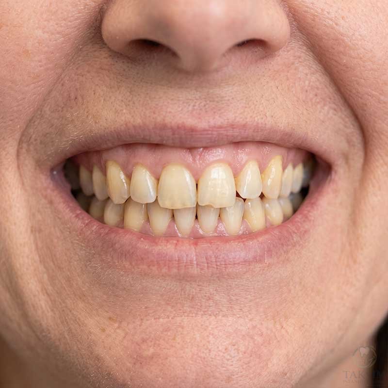 Teeth Before Cosmetic Treatment